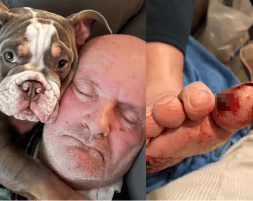 Man wakes to find his puppy has chewed his big toe to the bone but it saved his life